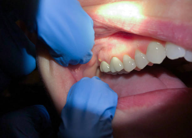 Best Emergency Treatment for Dental Infections or Abscesses in Port Lavaca, TX