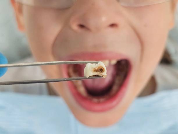 Best Emergency Tooth Extraction in Port Lavaca, TX